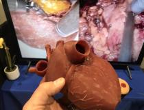 Example of flexible 3D printed heart that can be made to the exact size of a patient from their CT scan from Materialise. It can be used to practice procedures and check device sizing. 