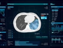 Artificial intelligence (AI) radiology company InterVision has modified its CT Pneumonia software to help auto detect COVID-19 on computed tomography scans. The technology was put into use in China early on in the epidemic to help screen large volumes of patients and flag those with radioman symptoms for stat reads. #SARScov2