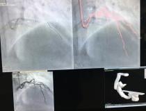 #TCT2019 #TCT #TCT19 An example of Philips' vascular roadmapping technology, which fuses a CT or a rotational angiography 3-D coronbary tree model to live fluoro to help guide wires and devices without the need to use more contrast.