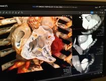 An example of a cardiac computed tomography (CT) exam showing a Medtronic CoreValve transcatheter aortic valve replacement (TAVR) device implanted. The image was reconstructed using Canon Medical’s Global Illumination photo-realistic rendering advanced visualization post-processing software. Vendors who offer this realistic type of CT image rendering say it is not used for diagnostics.  #SCCT2019 #SCCT