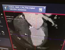 A CT evaluation of a TAVR valve from a Siemens Force CT system.
