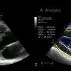 A new algorithmic module from OEM ultrasound AI software vendor RSIP Vision provides automated expert-level assessment of heart function from parasternal long axis view for point of care medical teams. Echocardiography artificial intelligence