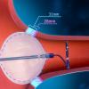 First-of-its-kind expandable cryoballoon catheter advances cryoablation therapy, addresses key limitations with traditional systems 