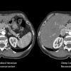 Canon Medical Receives FDA Clearance for AiCE Reconstruction Technology for CT