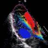 AMID's high definition blood flow tracking software for echocardiography.