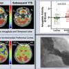 Researchers found a relationship between stress-associated neurobiological activity on 18F-FDG PET-CT imaging and risk for subsequent Takotsubo syndrome impacting the heart.