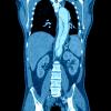 CT, computed tomography, IV contrast media, acute kidney injury risk, Annals of Emergency Medicine study