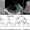 Figures from an initial study on the Cardionomic CPNS technology in a poster presentation at the Heart Rhythm Society (HRS) 2021 meeting.[1]  Starting at top left, an angiographic view of the atrial transseptal access for a left ventricular septal ablation. Procedural intra-cardiac echo (ICE) showing ablation catheter positioning. A 3D electro-anatomic map of the LV septum. The final graphs show baseline and post-procedure LVOT pressure readings demonstrating a decreased gradient.