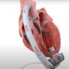 The CorWave LVAD uses a pulse pump rather than a rotary pump to move blood, so it more closely simulates the movement of blood in a read heart.