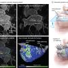 High-resolution 3-D delayed enhancement MRI of the left atrium can be used for quantification of fibrosis based on relative intensity of contrast enhancement The DECAAF study found this may help determine which patients will benefit from fibrosis ablation combined with PVI, and which ones are best served with the PVI.