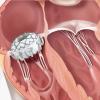 The Edwards Lifesciences Evoque transcatheter tricuspid valve replacement system demonstrated sustained favorable patient outcomes at six months in the TRISCEND study.
