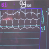 iRhythm and Stanford Researchers Develop Deep Learning-Based Cardiac Arrhthymia Detection Algorithm