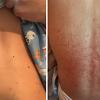 Exantham on abdomen and back of a pediatric patient at Nemours Children’s Health System in Delaware who presented with mysterious symptoms in what would later be identified as one of the first cases of multisystem inflammatory syndrome in children (MIS-C) in the United States.