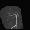 intracranial aneurysm, endovascular treatment, EVT, MRA, Naggara