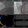 The Medis Quantitative Flow Ratio (QFR) is a novel, non-invasive, angiography-based physiologic FFR-like assessment of the presence and extent of coronary artery disease. 