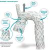 The Endospan Ltd. Nexus aortic arch stent graft is a CE mark–approved, off-the-shelf system for endovascular treatment of pathologies extending or involving the aortic arch.  #VIVA19 #VIVA2019