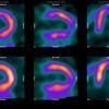 New Phase 2B Trial Exploring Target-Specific Myocardial Ischemia Imaging Agent