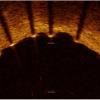 OCT, intravascular imaging, stent, good stent apposition on vessel wall, TRANSFORM-OCT study
