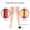 Study: Adherence to GDC Reduced Risk of Serious Limb Events at Two Years