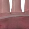 Protembis Announces Successful First-in-Human Use of  ProtEmbo Cerebral Protection System in European Trial