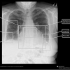 chest, x-ray, reporting, Qure.ai,