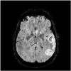 Majority of High-Risk Stroke Patients Not Being Screened for Common Risk Factors