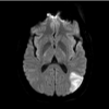 stroke, FDA seeks stroke registries, brain infarct