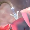 The new generation Abbott TriClip G4 device has gained European and Canadian approvals for transcatheter tricuspid valve repair (TTVR). 