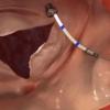 4Tech, TriCinch TTVR, transcather tricuspid valve repair device, first implant