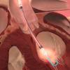 Pre-PCI Impella 2.5 Insertion Improves Survival in Left Main Coronary Artery Heart Attacks