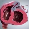 BioVentrix Announces Germany's First Revivent TC TransCatheter Ventricular Enhancement Procedure