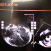 Conavi Medical Receives FDA Clearance for Feature Expansion on Foresight Intracardiac Echocardiography System