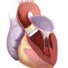 Northwestern Medicine, Edwards Lifesciences, Intuity Elite suturless aortic valve, first in Illinois