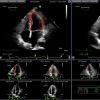 Strain Imaging Improves Cardiac Surveillance of Certain Breast Cancer Patients