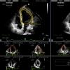 Epsilon Imaging, EchoInsight, left ventricle, LV measurement, strain imaging, ASE 2016