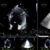 Epsilon Imaging Echo insight (echoinsight) strain imaging on cardiac ultrasound