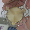 Two-Year Results CoreValve U.S. Pivotal Trial TCT 2014