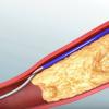 Philips Announces Relaunch of Pioneer Plus IVUS-Guided Catheter