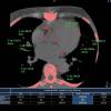 An example of a CT coronary artery calcium scoring exam showing how each vessel segment is scored to assess a patient's risk for a future heart attack. Example is from Philips Healthcare.