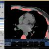 heart CT scans, coronary calcium score, disease risk, Johns Hopkins study