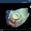 SCAI Issues Position Statement on Adult Congenital Cardiac Interventional Training, Competencies and Organizational Recommendations. A congenital atrial septal defect closed using a transcatheter occluder, visualized on 3-D TEE ultrasound.  