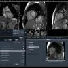 Johns Hopkins, motion-tracking MRI, stroke risk, atrial fibrillation