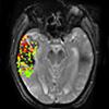 DEFUSE-2 study, MRI, brain bleeding risk, post-stroke treatment, NIH