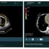 Zebra Medical Vision now offers artificial intelligence (A) medical imaging analytics for its cardiac solution HealthCCSng, which enables the quantification of the coronary artery calcium (CAC) on CT scans as an incidental finding. Zebra gained FDA clearance for the product in September 2021.