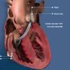 Illustration showing the venous implantation route and where the inlet and outflow ports are when the Abiomed Impella RP is placed in the right side of the heart. The  Impella RP catheter is used for right heart hemodynamic support. 
