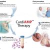 The BioCardia cardiac stem cell CardiAMP trial is a Phase III study looking at the efficacy of using stem cells to improve heart function in heart failure patients. It is the first trial for this technology to reach Phase III trial.