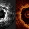 bioresorbable stents, bioabsorbable stents, visualizing the Absorb BVS, dissolving stent, disappearing stent on IVUS and OCT