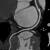 Cardiac coronary calcium scoring.