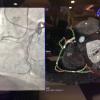 An example of Siemens' syngo CTO navigation technology that fuses computed tomogragraphy (CT) imaging with live angiography to help navigate vessel segments that are occluded and not visible on angiography alone. 