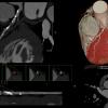 CT angiography, CTA, coronary CT, cardiac CT, SCCT, society of cardiovascular computed tomography, cardiac imaging